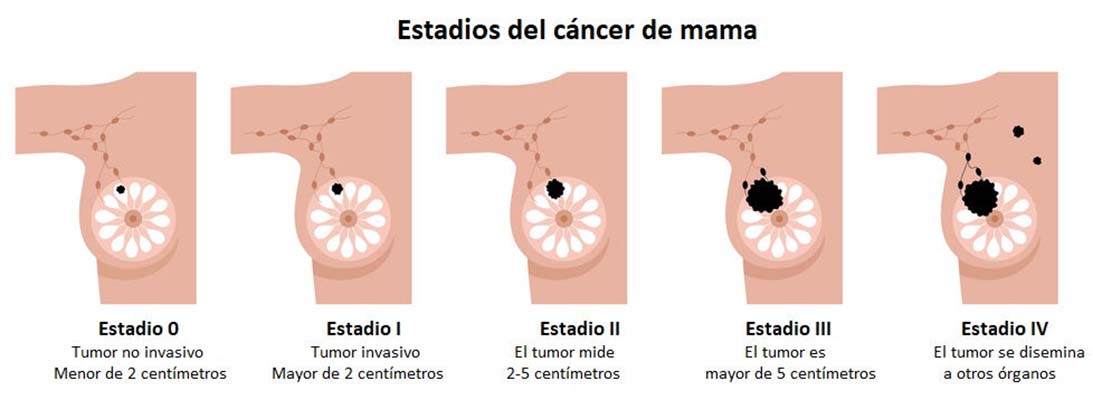 Cáncer de mama 4