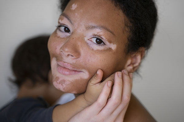 Micronutrientes, tratamiento alternativo para el vitiligo 3